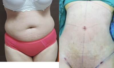 Laser Liposuction before and after photo