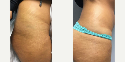 Microneedling before and after photo