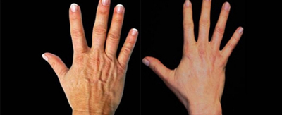 Dermal Fillers before and after photo