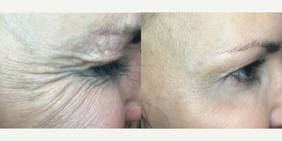 Dysport before and after photo