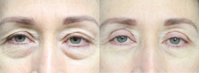 Eyelid Surgery before and after photo