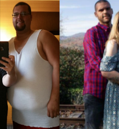 Gastric Bypass before and after photo