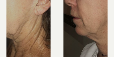 Morpheus8 before and after photo