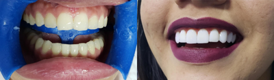 Porcelain Veneers before and after photo