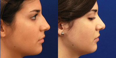 Rhinoplasty before and after photo