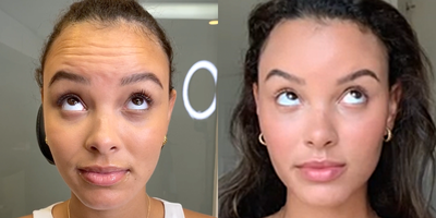 Botox before and after photo