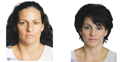 Brow Lift before and after photo