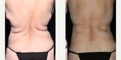 CoolSculpting before and after photo