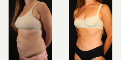 Tummy Tuck before and after photo