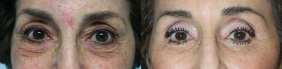 Eyelid Surgery before and after photo