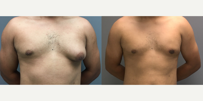 Gynecomastia Surgery before and after photo