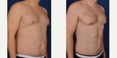 Liposculpture before and after photo