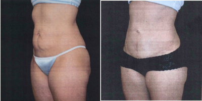 Liposuction before and after photo