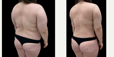 Liposuction before and after photo