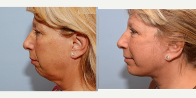 Neck Lift before and after photo