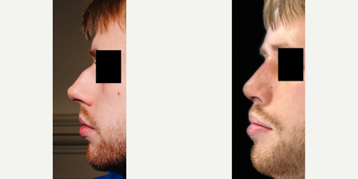 Rhinoplasty before and after photo