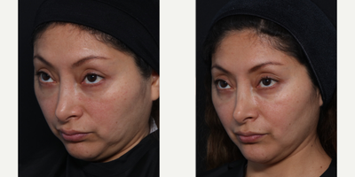 Botox before and after photo