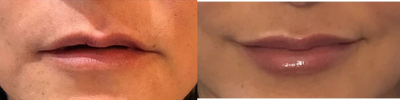 Dermal Fillers before and after photo