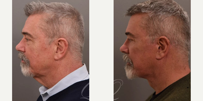 Eyelid Surgery before and after photo