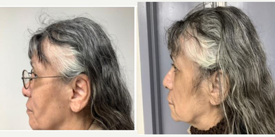 Hair Loss Treatment before and after photo