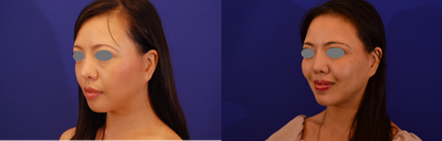 Revision Rhinoplasty before and after photo