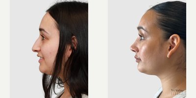 Rhinoplasty before and after photo