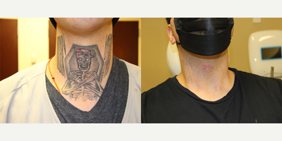 Tattoo Removal before and after photo