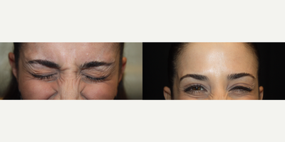 Botox before and after photo