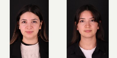 Chin Liposuction before and after photo