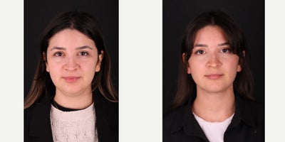 Chin Liposuction before and after photo
