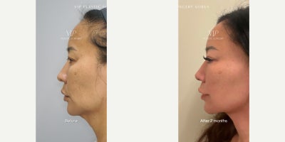 Deep Plane Facelift before and after photo