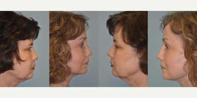 Facelift before and after photo