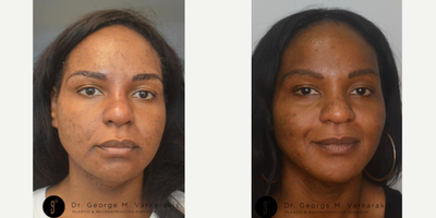 Facial Fat Transfer before and after photo