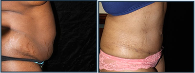 Tummy Tuck before and after photo