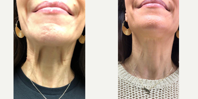 Botox before and after photo