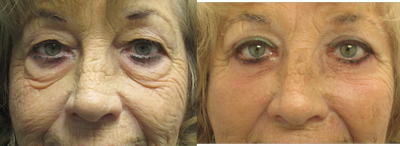 Cheek Lift before and after photo