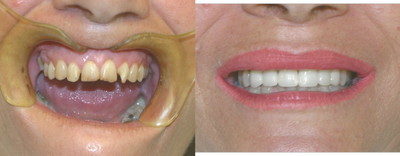 Smile Makeover before and after photo