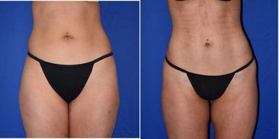 Abdominal Etching before and after photo