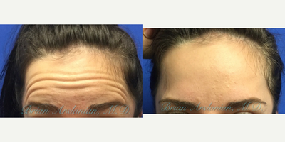 Botox before and after photo