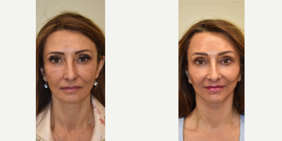 Facial Fat Transfer before and after photo