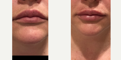 Lip Fillers before and after photo