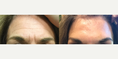 Botox before and after photo