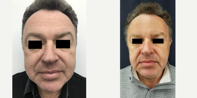 Botox before and after photo