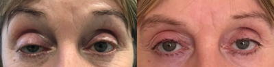 Eyelid Surgery before and after photo