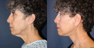 Facelift before and after photo