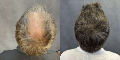 Hair Loss Treatment before and after photo