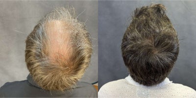 Hair Loss Treatment before and after photo