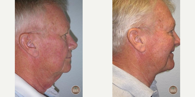Neck Lift before and after photo