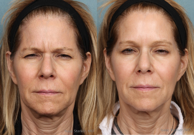 Botox before and after photo
