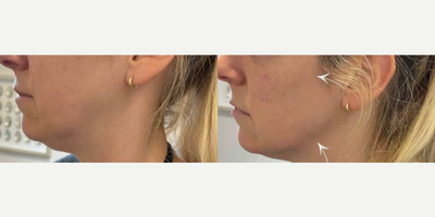 Cheek Fillers before and after photo